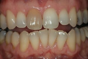 discolored tooth dark tooth dead tooth RCT