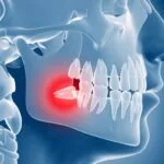 Wisdom Tooth Removal in Malaysia: Cost, Recovery & Myths (2025 Guide)