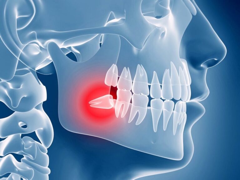 Wisdom tooth removal in Malaysia – cost, recovery, myths