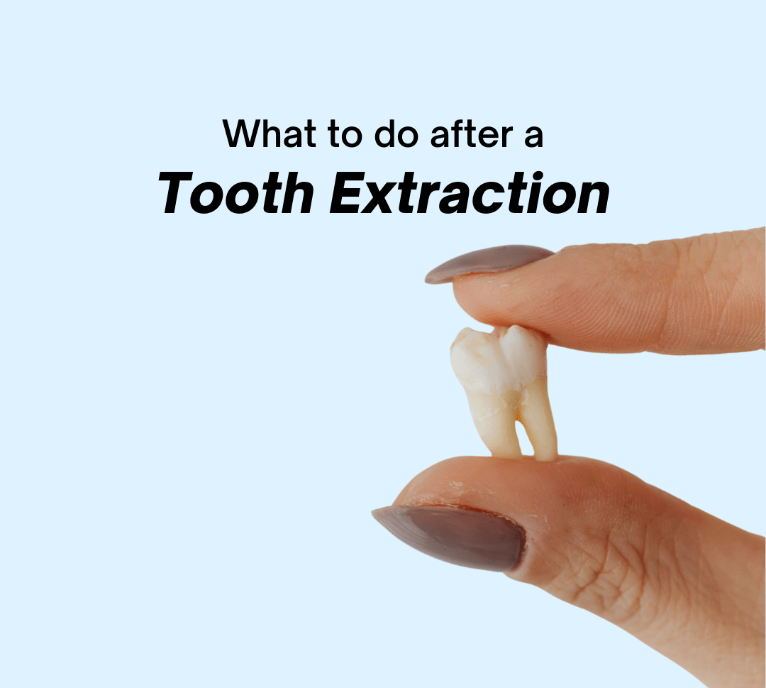 What_to_do_after_tooth_extraction_instructions