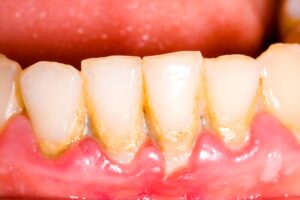 tooth-plaque-tartar
