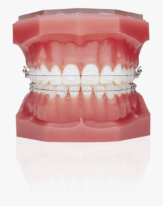 ceramic-braces-enlight-dental-kota-kinabalu