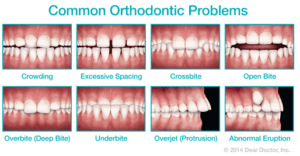 do-i-need-braces