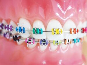 traditional-braces-colorful