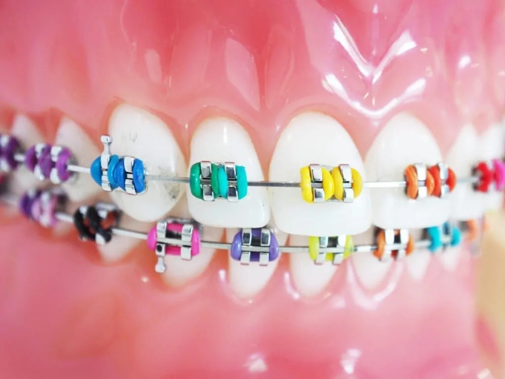 Traditional-braces-colorful
