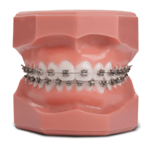 selfligating-braces-enlightdental-kotakinabalu