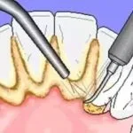 Dental scaling. What’s next?