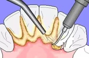 dental_scaling