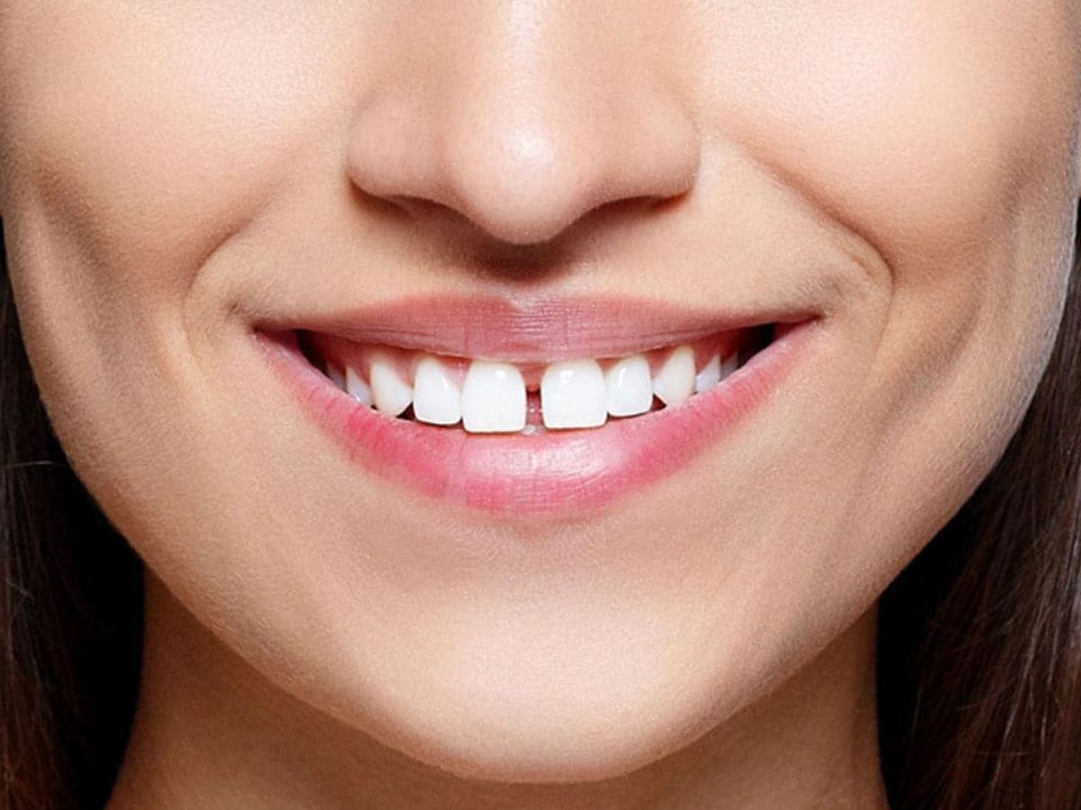 smile Gaps between teeth