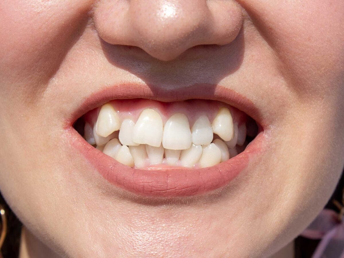 Crooked or overlapping teeth