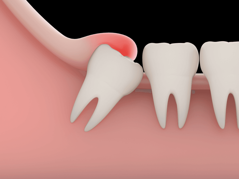 wisdom tooth minor surgery