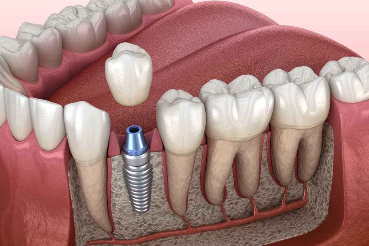 Dental Implants 12 Single tooth implant