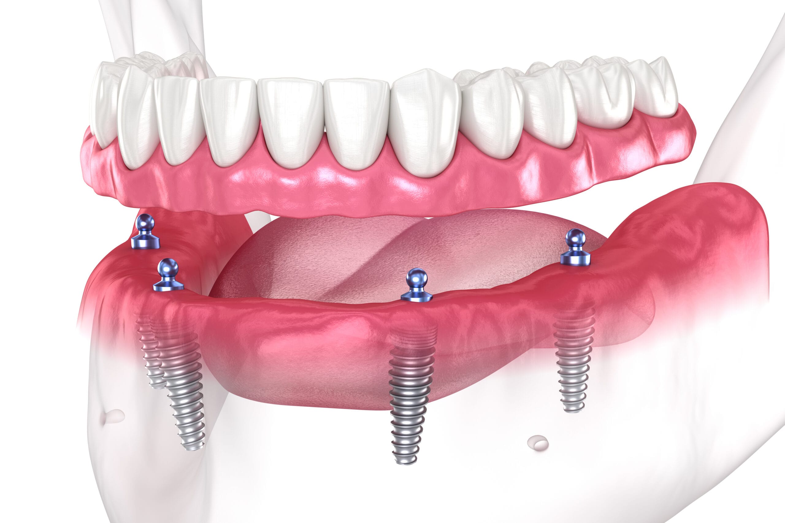Dental Implants 15 Implant supported denture