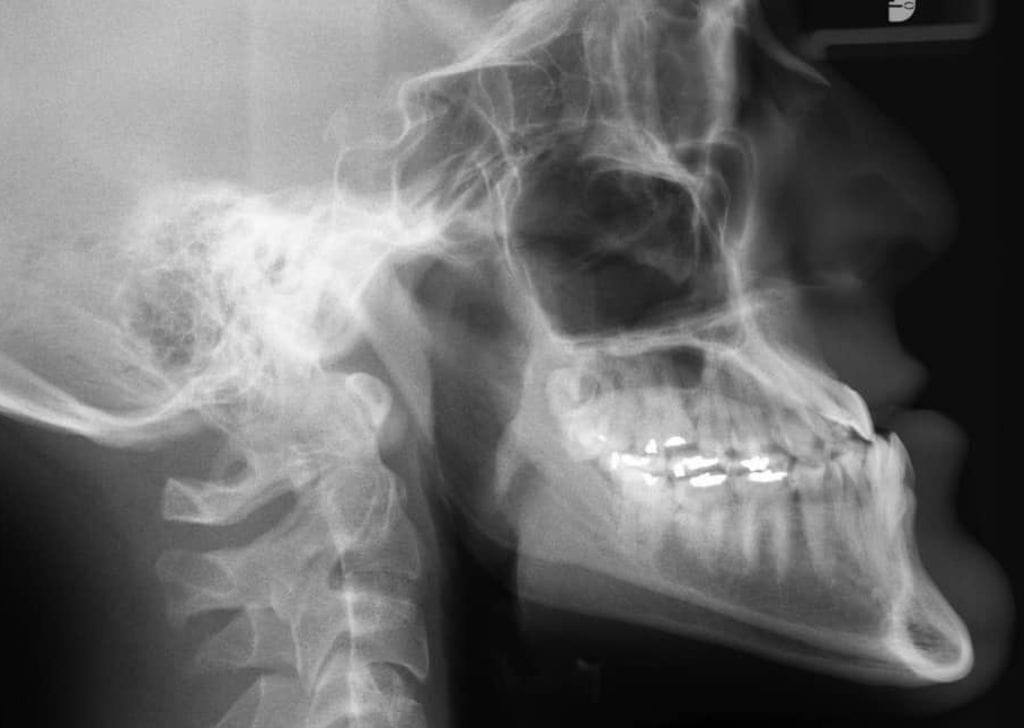 Dental Implants 16 Jawbone xray