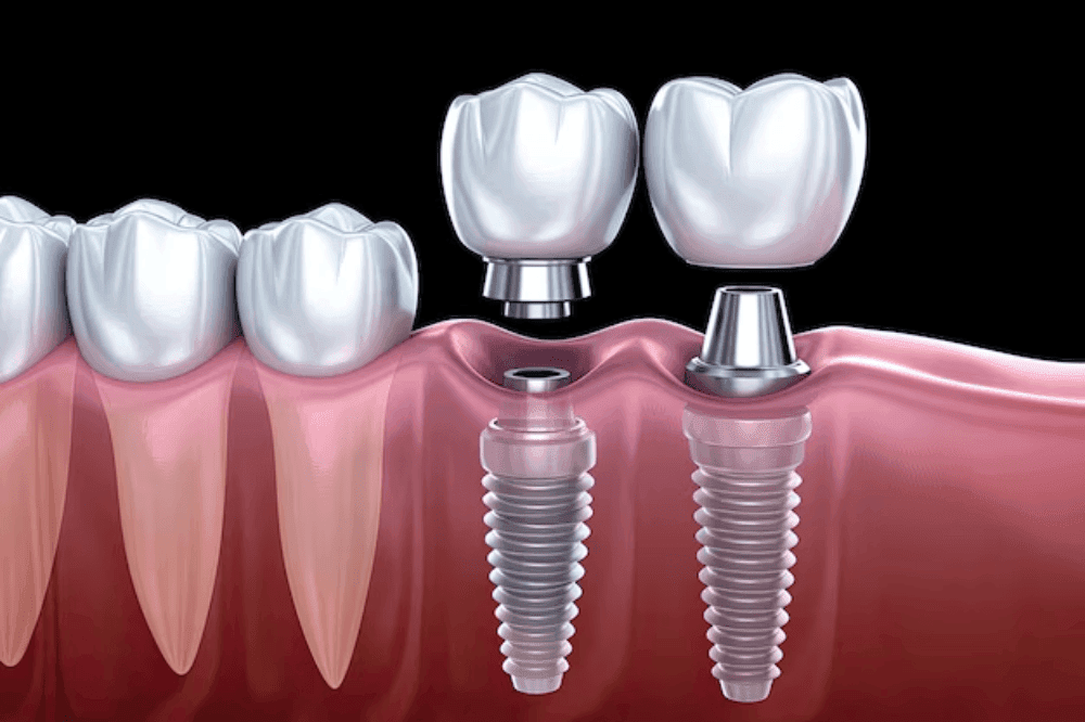 Dental Implants 13 Dental implant malaysia