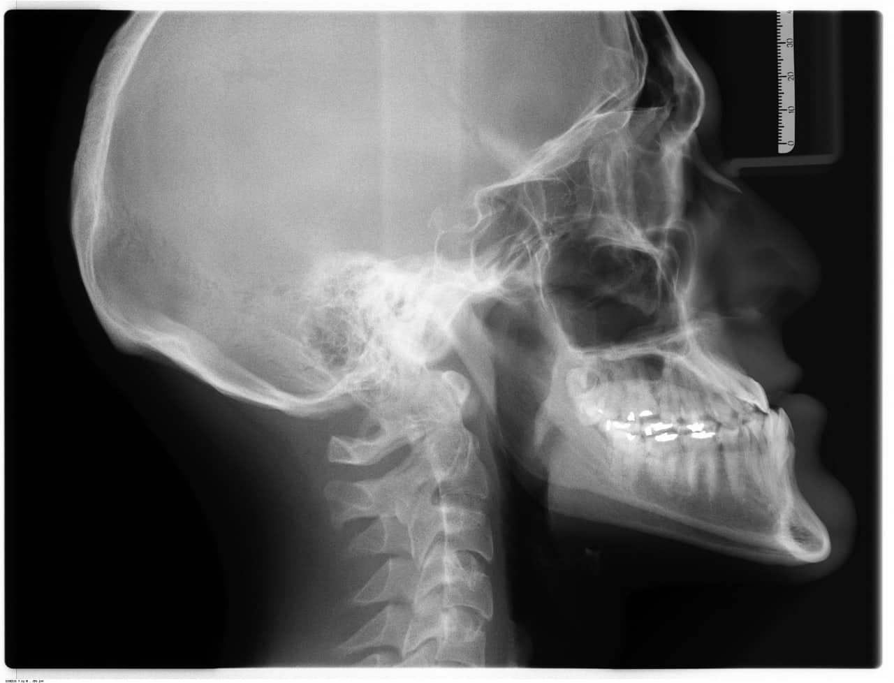 Jawbone xray