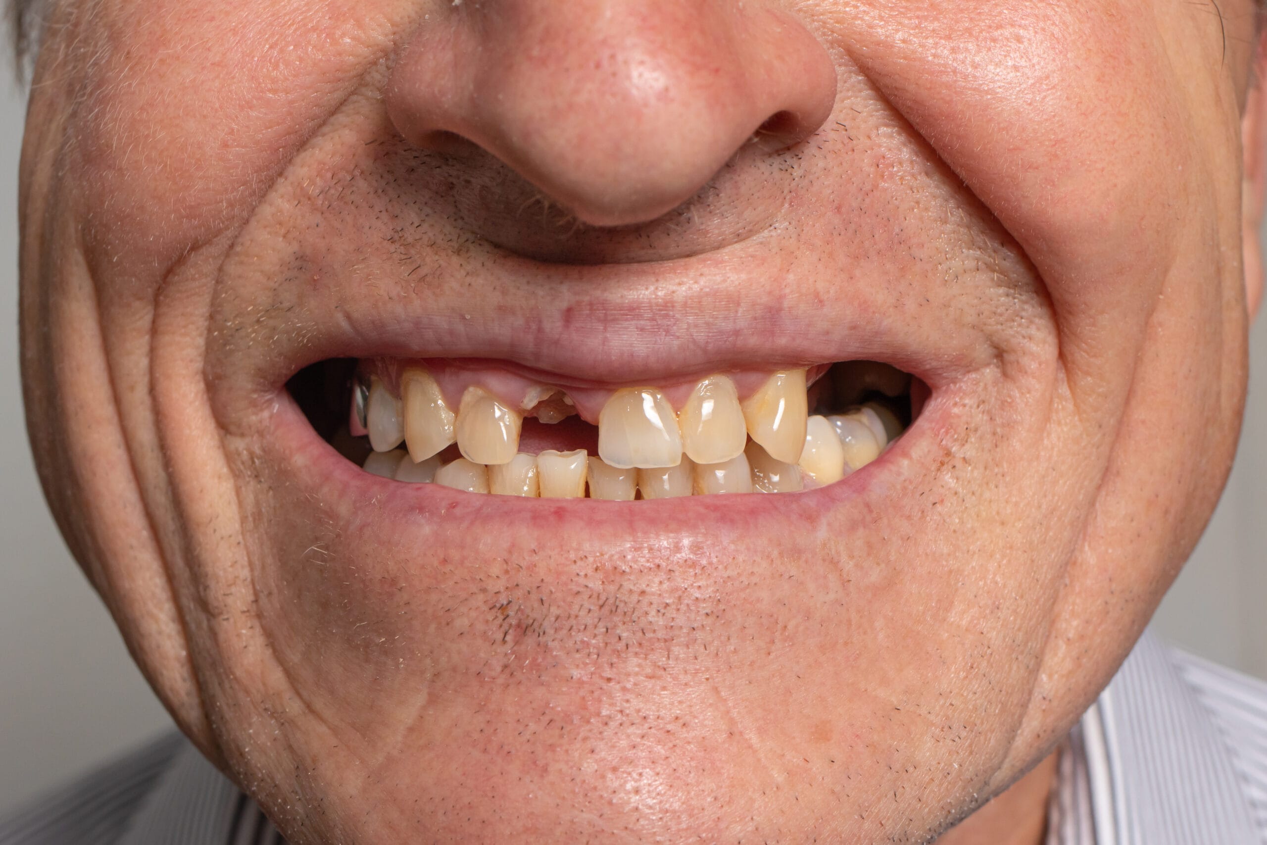 Gaps tooth loss