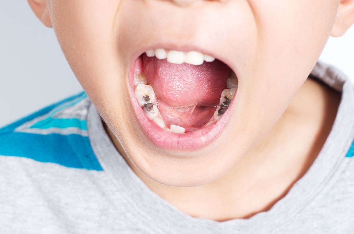 Cavities in children