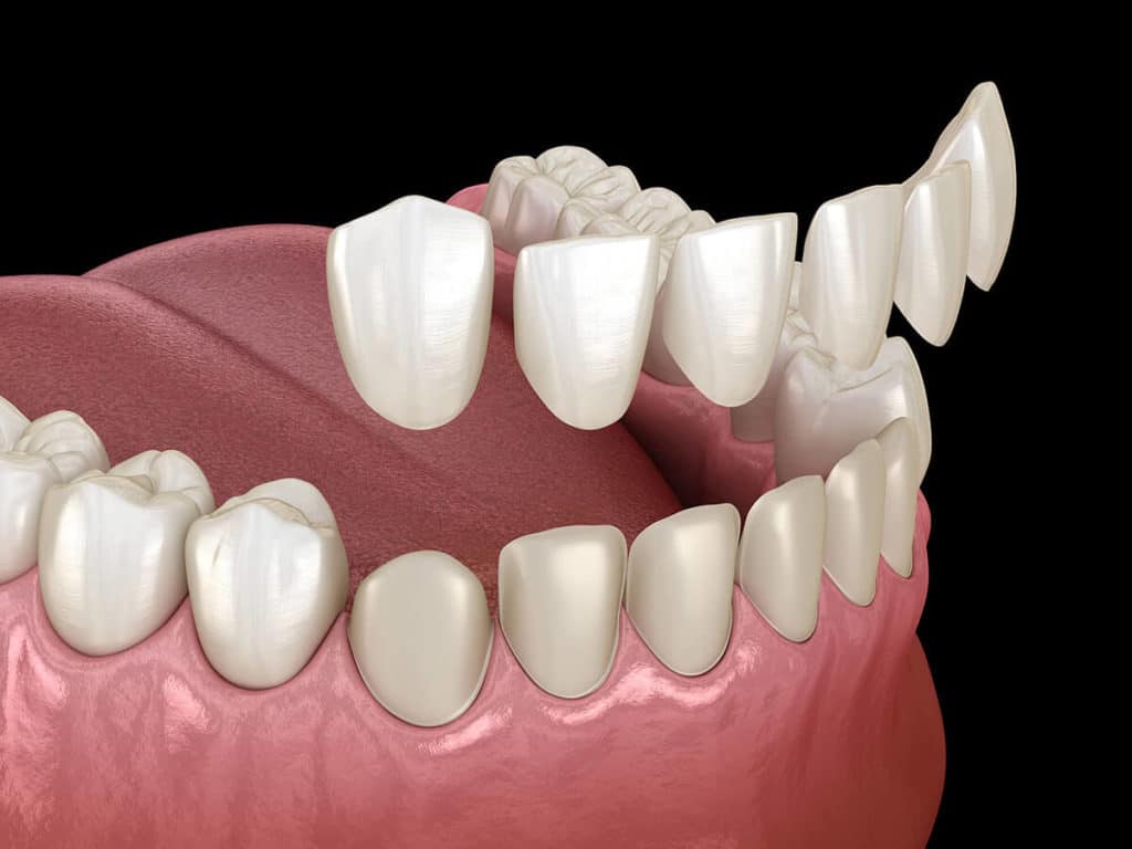 Cosmetic Dentistry In Kota Kinabalu 2 Porcelain veneers