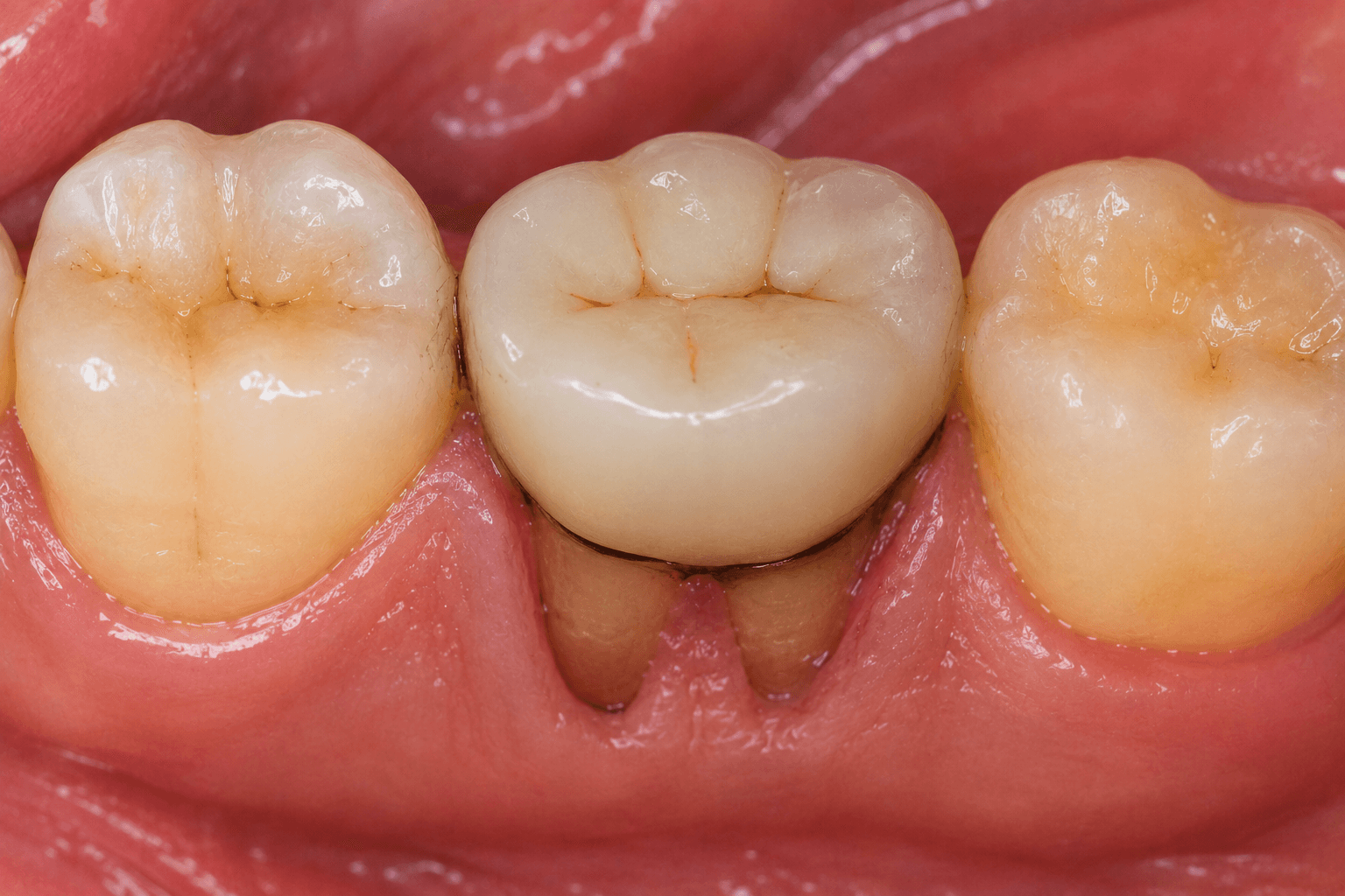 Root canal treated teeth