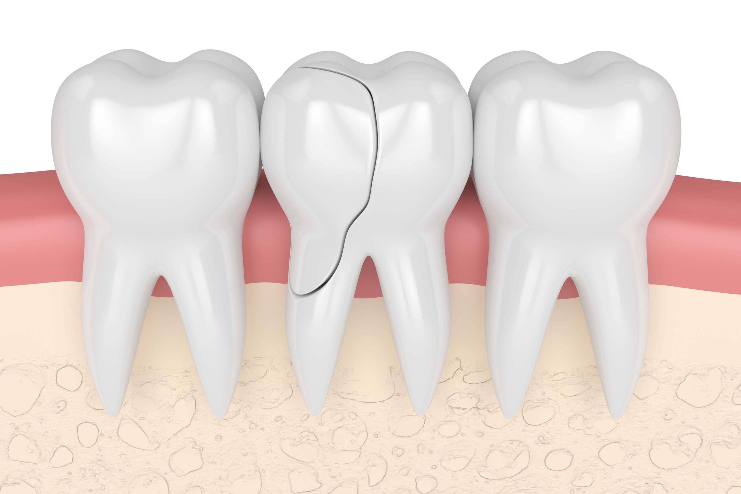 Cracked teeth