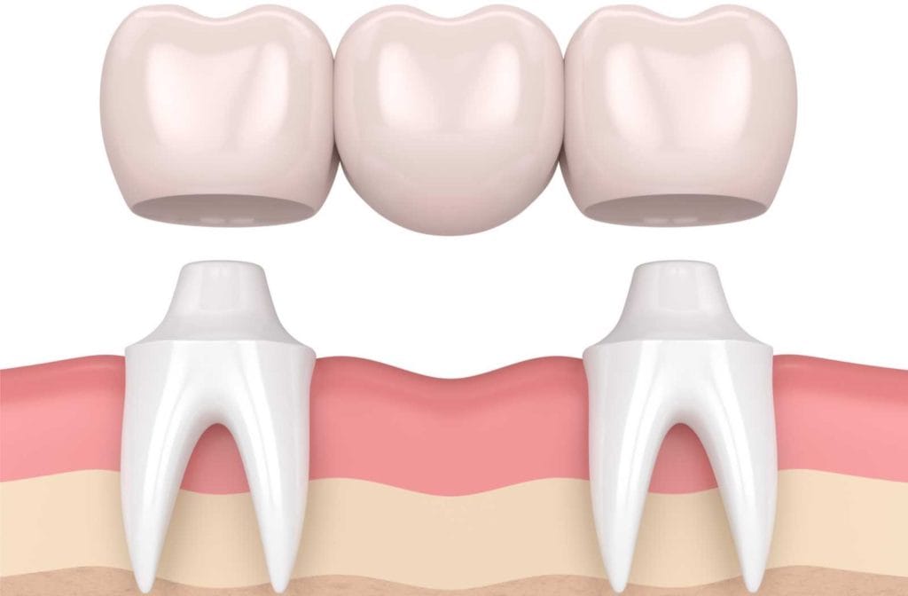 Dental bridge