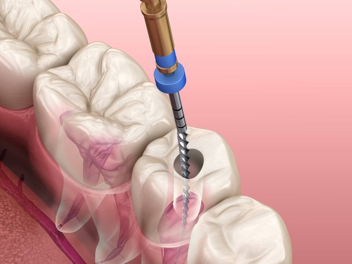 Home - Enlight Dental 14 Root canal