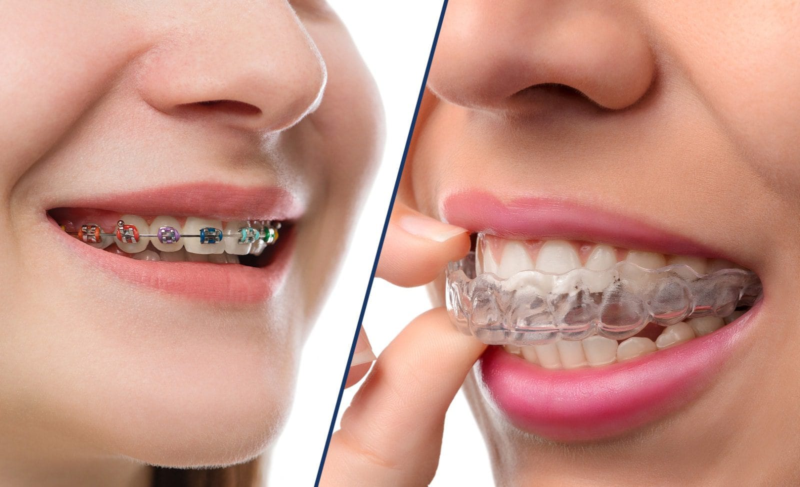aligners vs braces