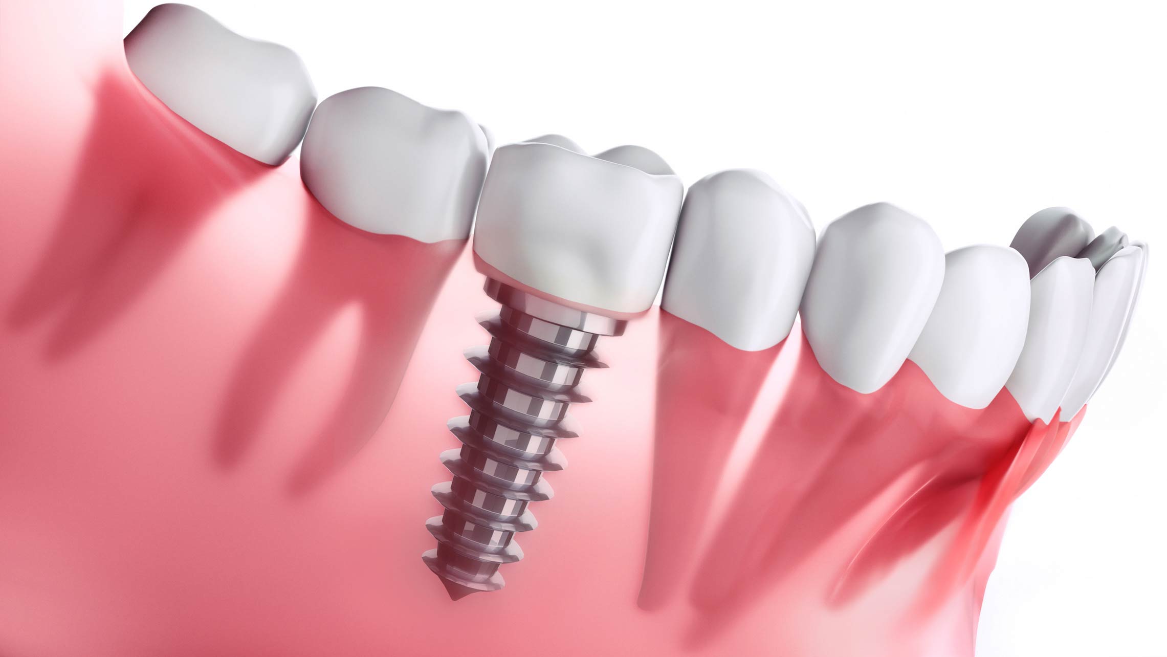 Dental implant