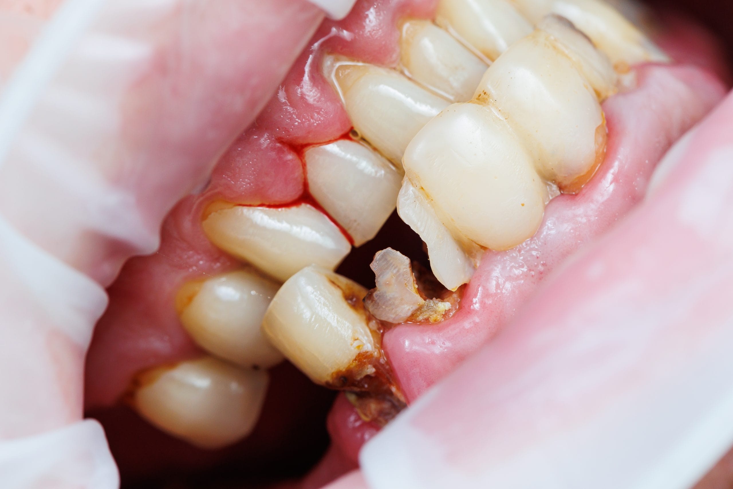 Damaged tooth