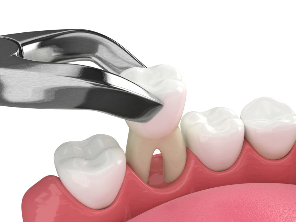 Home - Enlight Dental 13 Tooth extraction