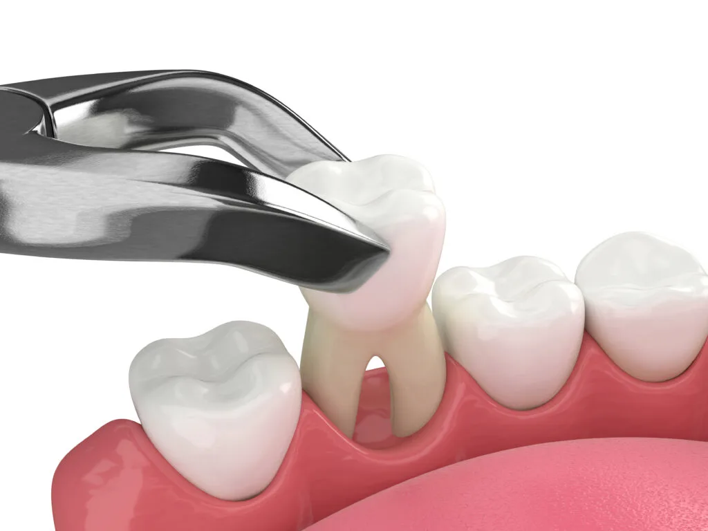 Tooth extraction