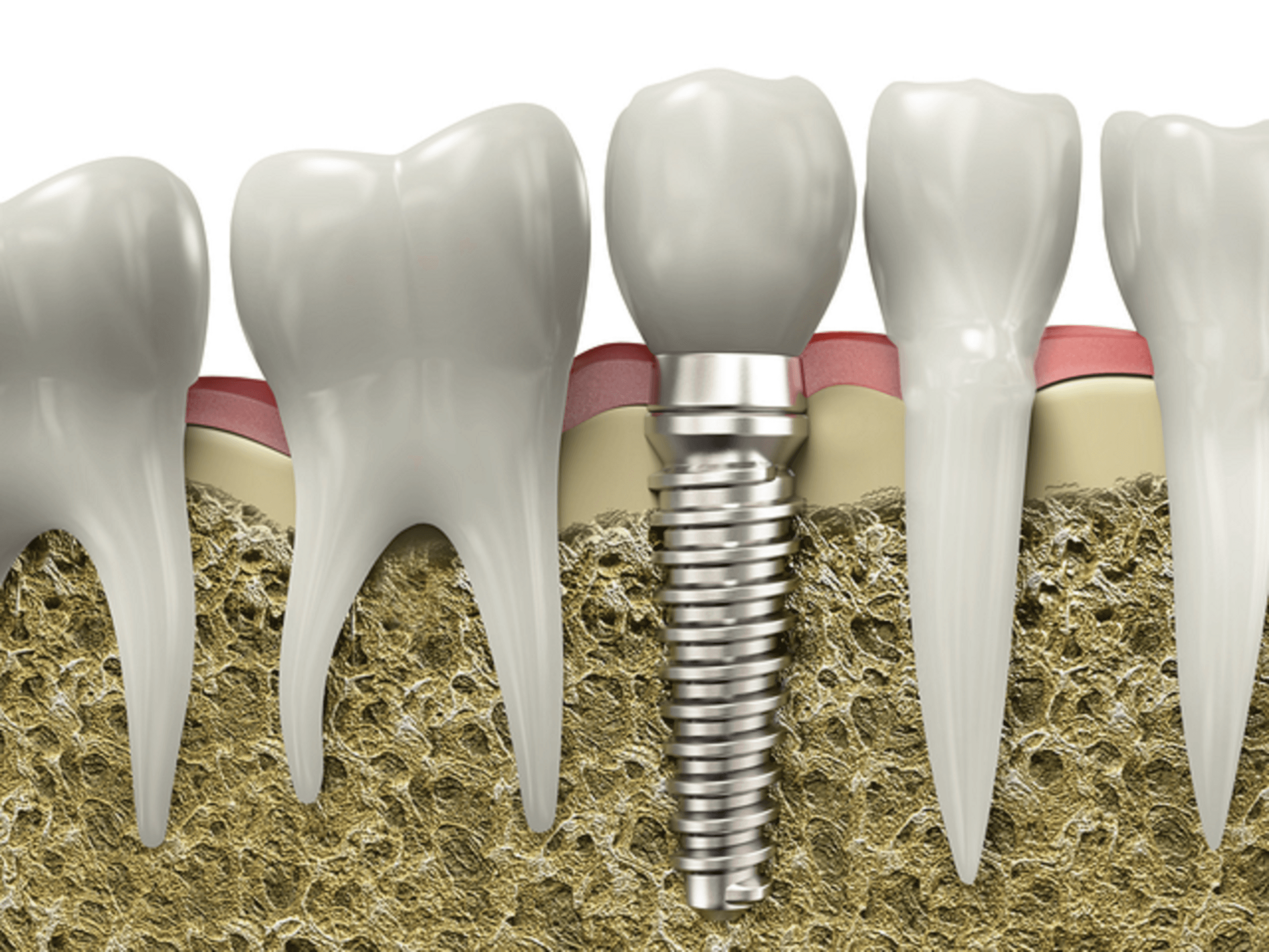 Zirconia implant