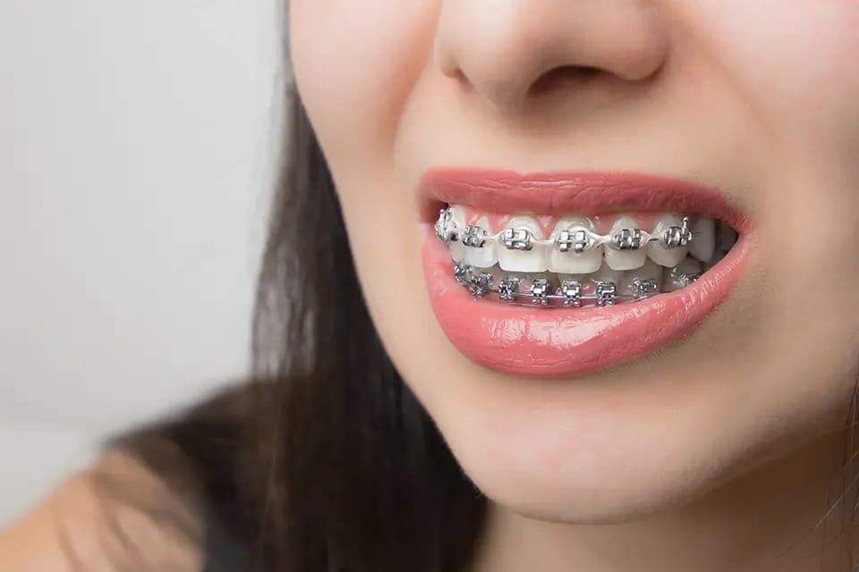 Self ligating braces