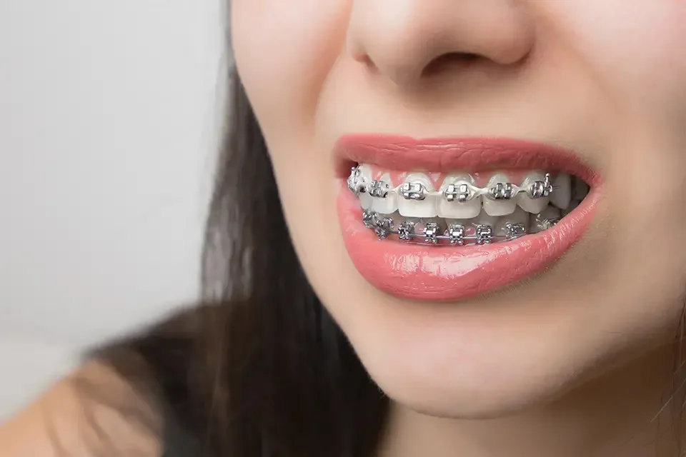 How To Choose The Right Type Of Braces For Your Teeth 3 Self ligating braces