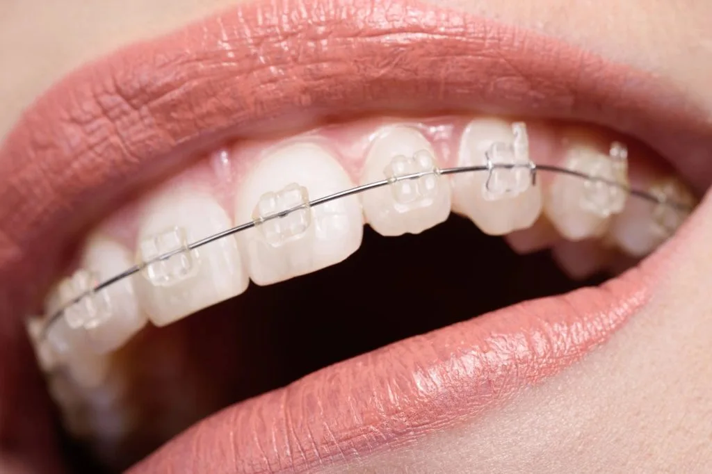 How To Choose The Right Type Of Braces For Your Teeth 2 Ceramic braces