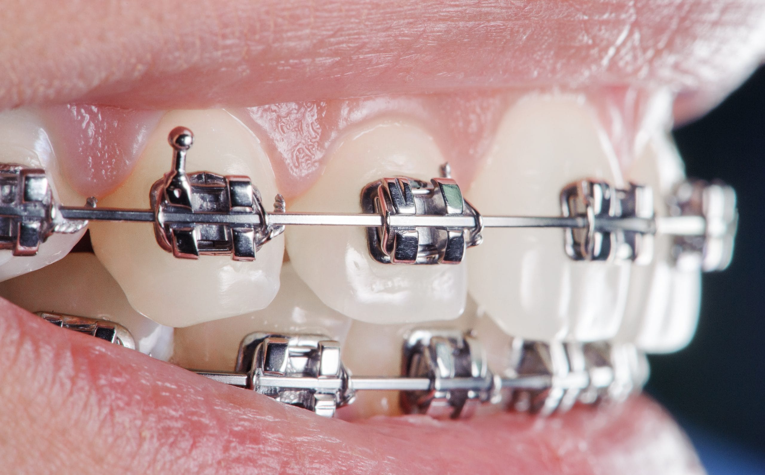 How to choose the right type of braces for your teeth