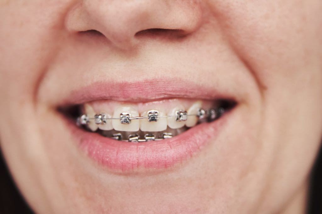 Metal braces