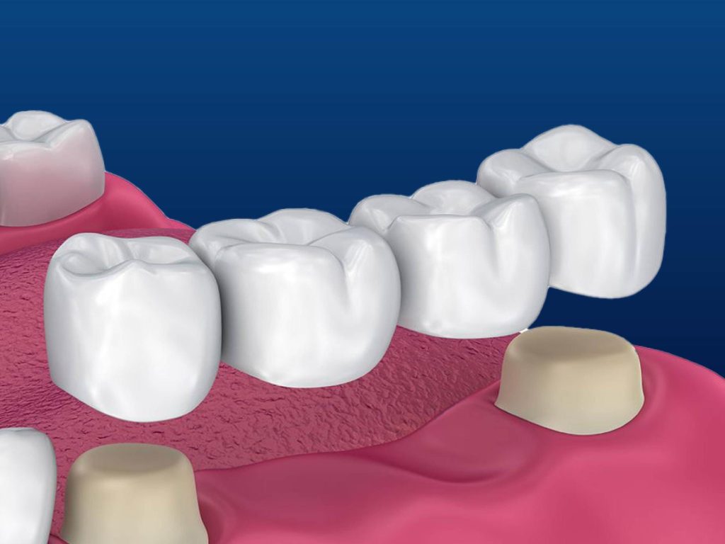 Traditional dental bridge