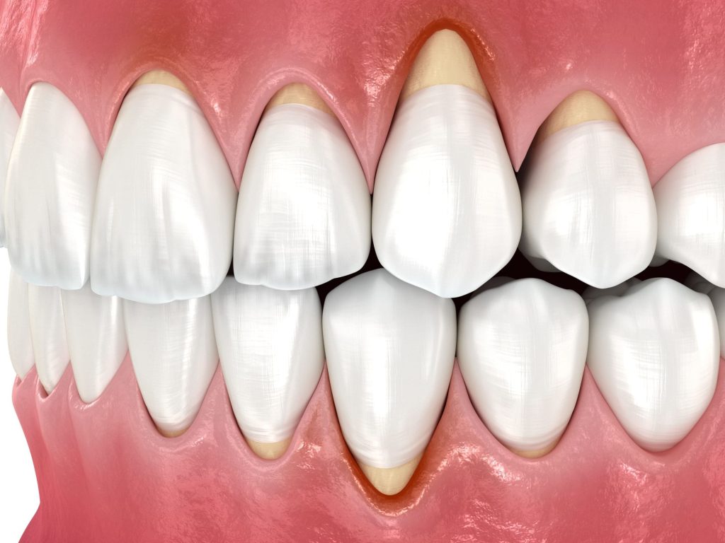 Gum recession