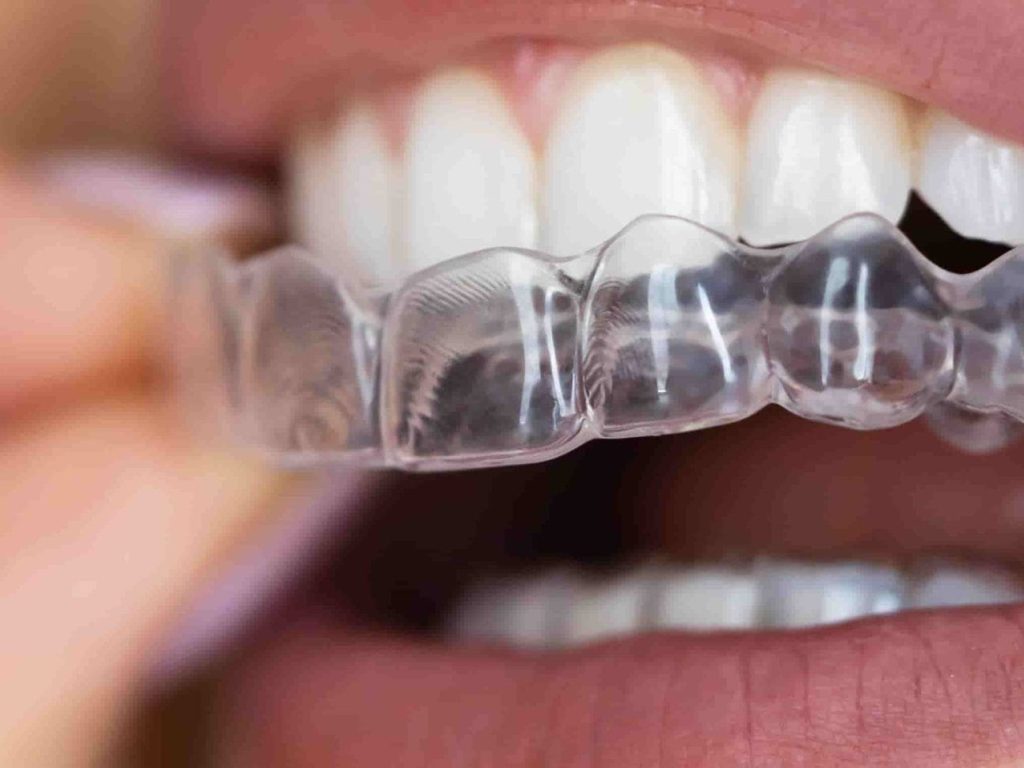 How do clear aligners work