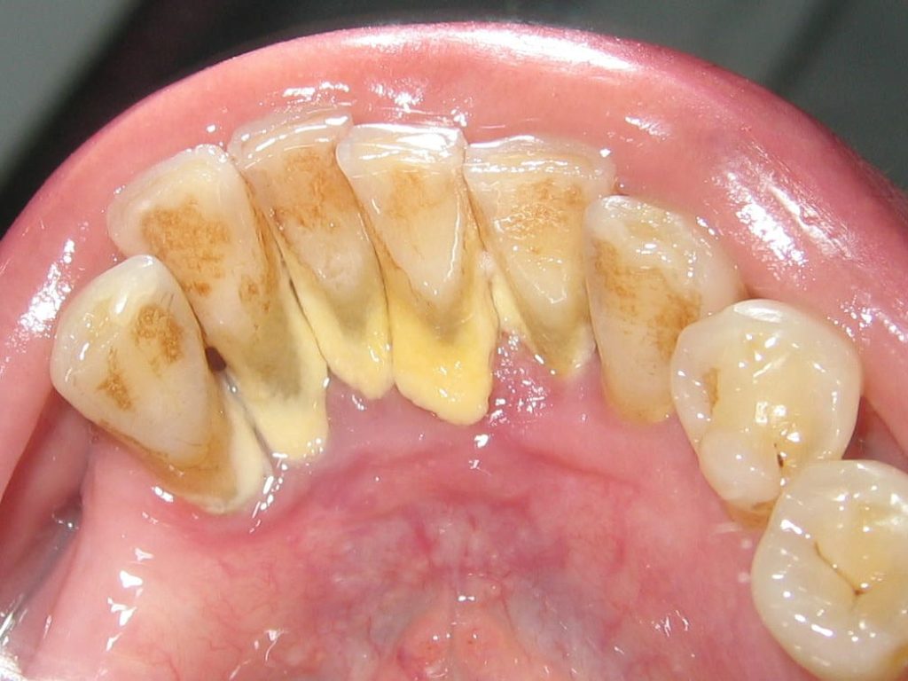 Plaque dental