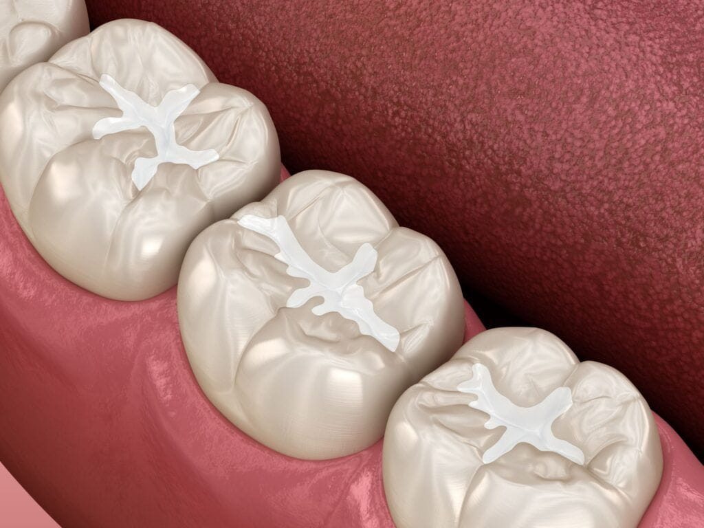 Dental sealant