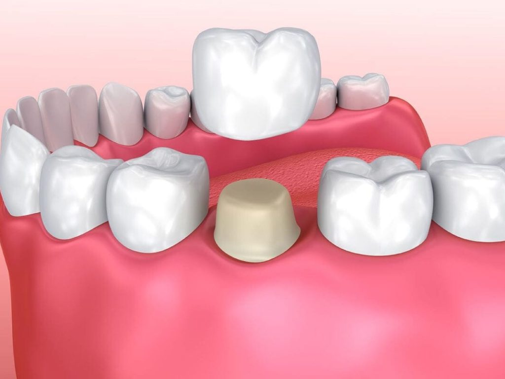 Porcelain crowns