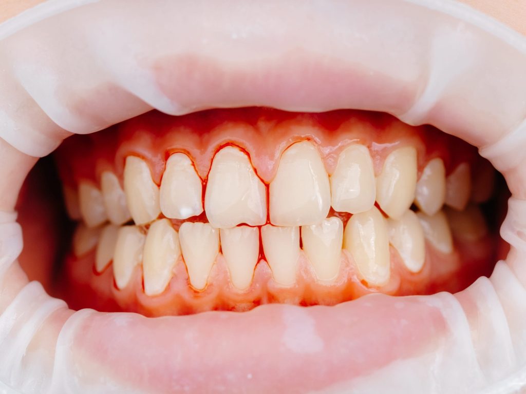 Dentist examining patient teeth using cheek retractor during dental procedure