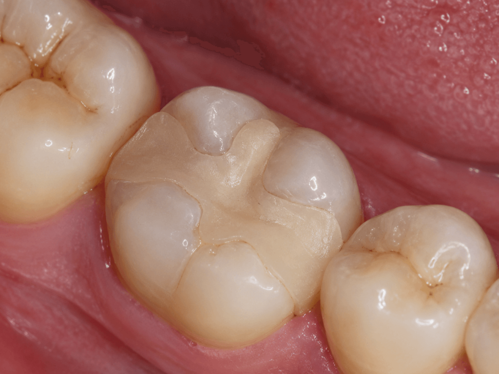 Composite onlay restorations