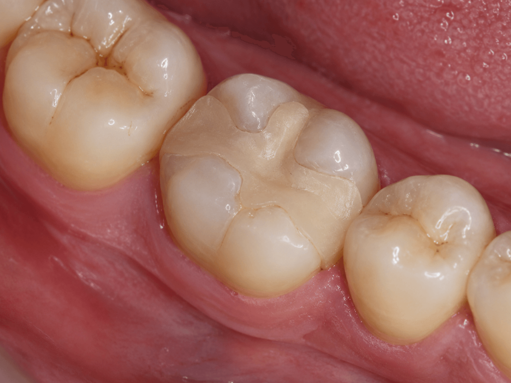 Composite onlay restorations
