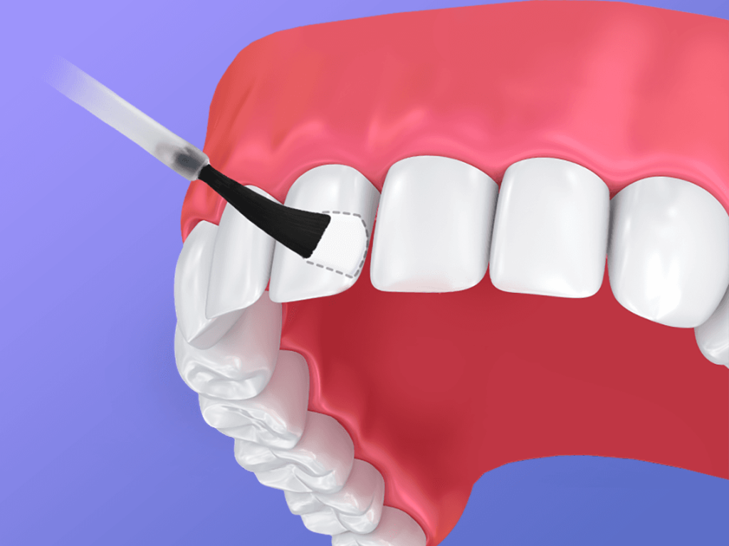 Fluoride-treatment