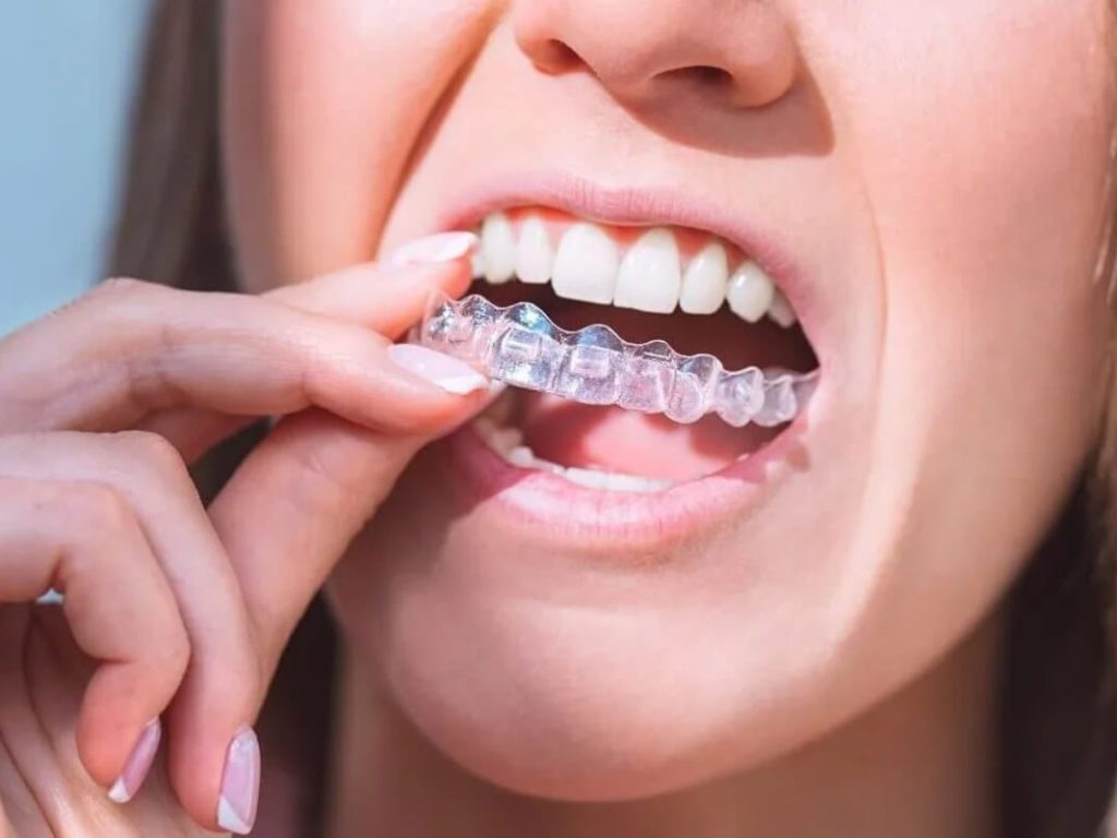 Wearing ur trays teeth