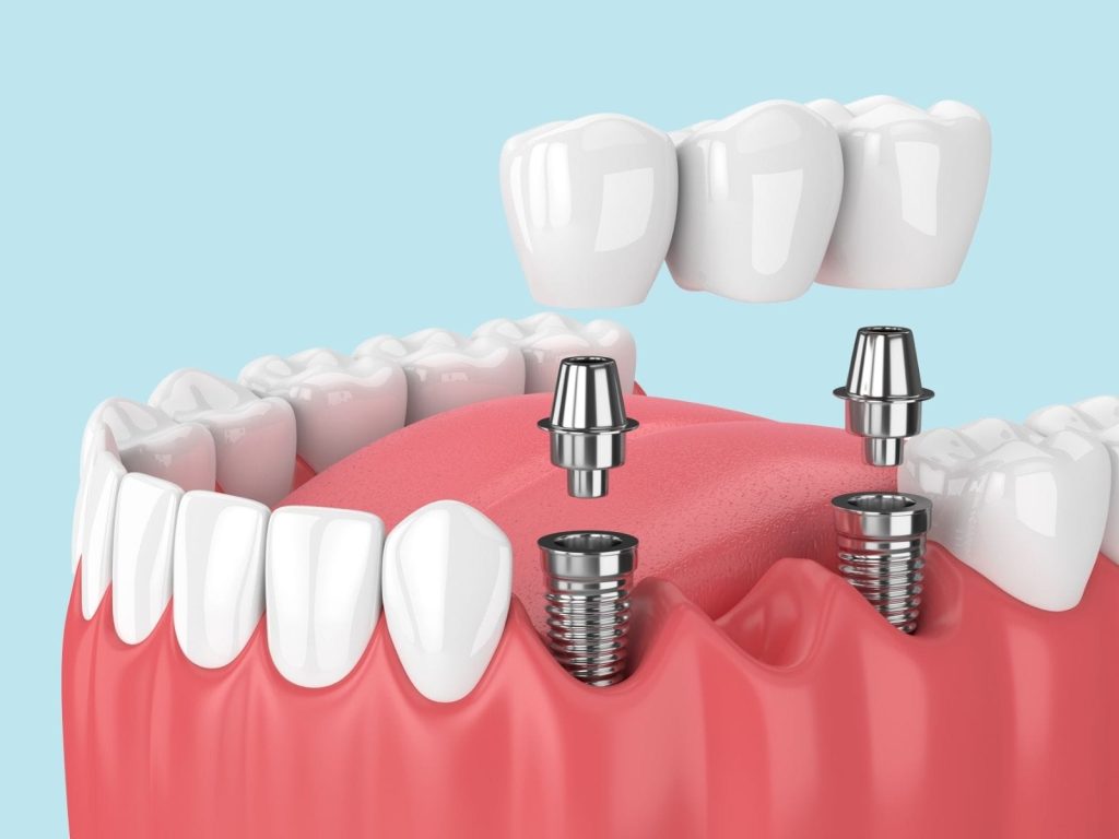 Implant supported bridge